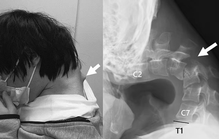 Excessive Mobile Gaming Forces 25-Year-Old in Japan to Undergo Emergency Spinal Surgery 1